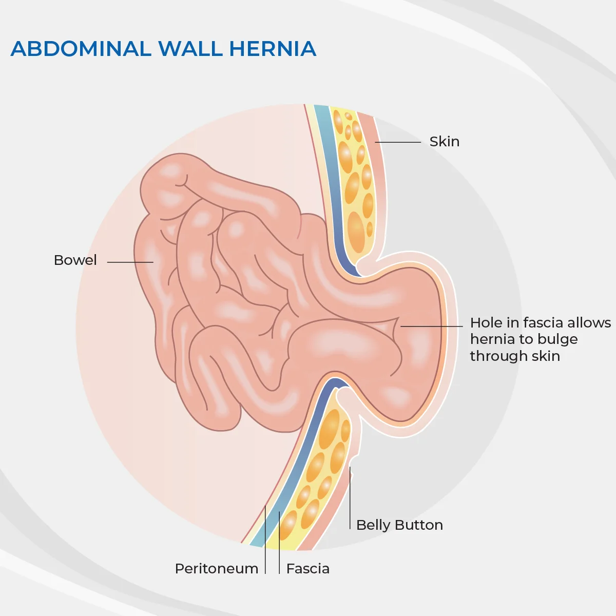 Umbilical Hernia Surgery