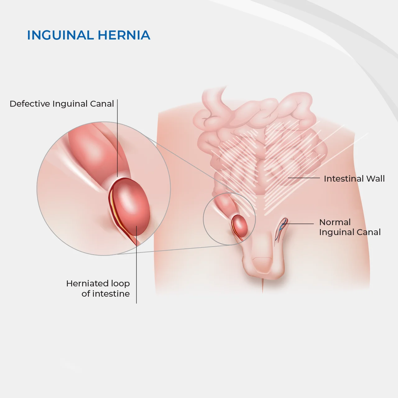 scrotal hernia